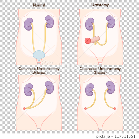 Urinary stoma, stoma, urostomy, ostomate, illustration 117511351