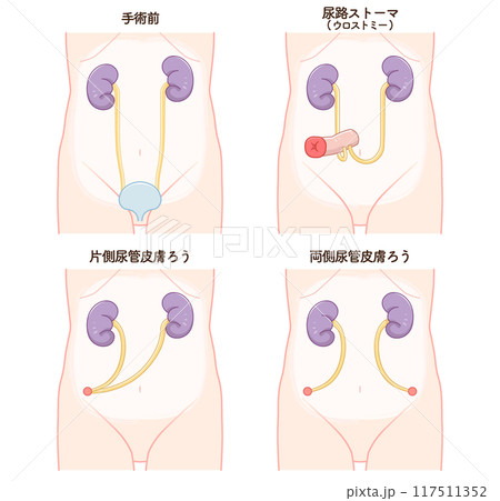 尿路ストーマ、ストーマ、ウロストミー、urostomy、オストメイト、イラスト 尿路ストーマ、ストーマ、ウロストミー、urostomy、オストメイト、イラスト 117511352