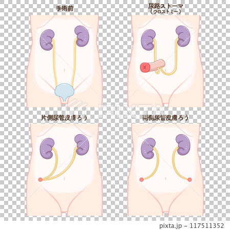 Urinary stoma, stoma, urostomy, ostomate, illustration Urinary stoma, stoma, urostomy, ostomate, illustration 117511352