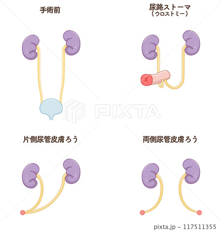 尿路ストーマ、ストーマ、ウロストミー、urostomy、オストメイト、イラスト 117511355