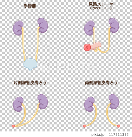 尿路ストーマ、ストーマ、ウロストミー、urostomy、オストメイト、イラスト 117511355