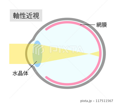 軸性近視の眼球のシンプルなイラスト 117511567