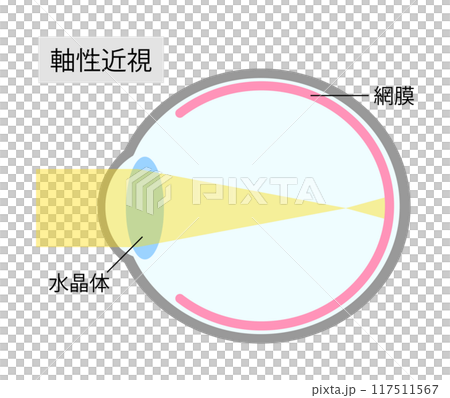 軸性近視の眼球のシンプルなイラスト 117511567