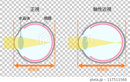 正視と軸性近視の眼球のシンプルな比較イラスト横 117511568