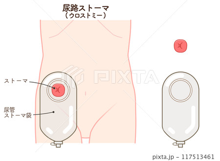 尿路ストーマ、ストーマ、ウロストミー、urostomy、オストメイト、イラスト 尿路ストーマ、ストーマ、ウロストミー、urostomy、オストメイト、イラスト 117513461