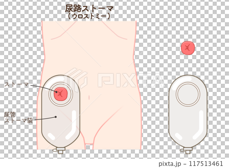 尿路ストーマ、ストーマ、ウロストミー、urostomy、オストメイト、イラスト 尿路ストーマ、ストーマ、ウロストミー、urostomy、オストメイト、イラスト 117513461