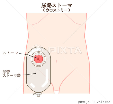 尿路ストーマ、ストーマ、ウロストミー、urostomy、オストメイト、イラスト 尿路ストーマ、ストーマ、ウロストミー、urostomy、オストメイト、イラスト 117513462