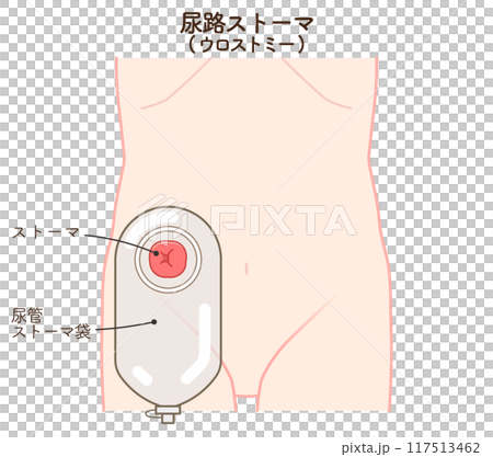 尿路ストーマ、ストーマ、ウロストミー、urostomy、オストメイト、イラスト 尿路ストーマ、ストーマ、ウロストミー、urostomy、オストメイト、イラスト 117513462