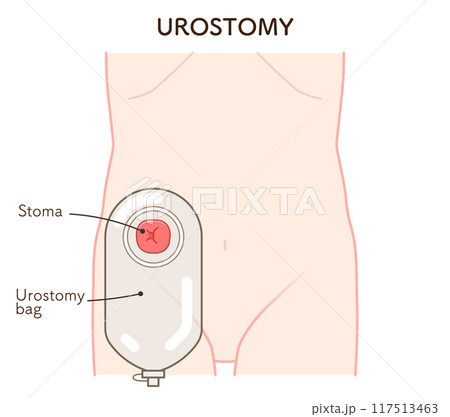 尿路ストーマ、ストーマ、ウロストミー、urostomy、オストメイト、イラスト 117513463