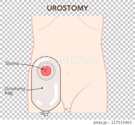 尿路ストーマ、ストーマ、ウロストミー、urostomy、オストメイト、イラスト 117513463