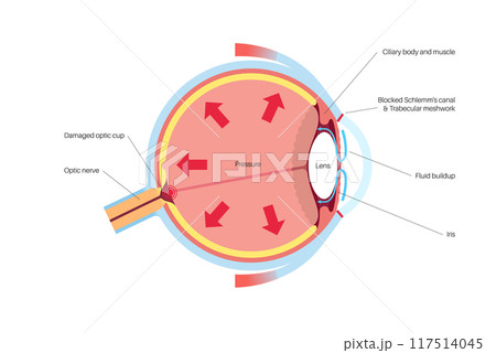 Glaucoma eye pressure 117514045