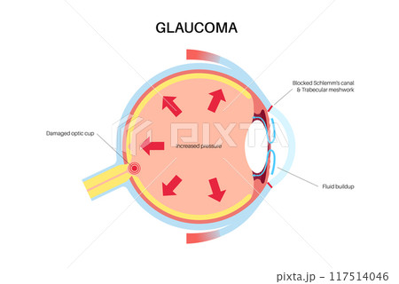 Glaucoma eye pressure 117514046
