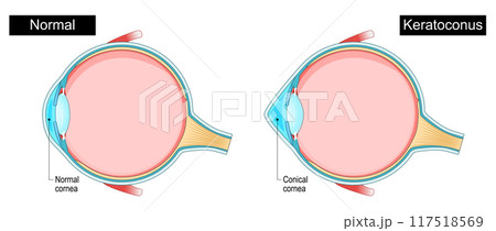 Keratoconus. Eye disorder. Corneal thinning. Progressive eye disease. Keratoconus. Eye disorder. Corneal thinning. Progressive eye disease. 117518569