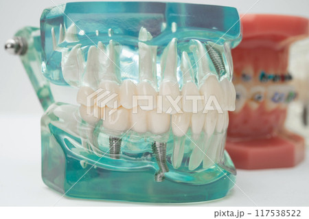 Artificial tooth roots dental implant into jaw, Root canal model for dentist. Artificial tooth roots dental implant into jaw, Root canal model for dentist. 117538522