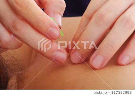 鍼灸院で背中に鍼治療をする女性 鍼灸院で背中に鍼治療をする女性 117552992