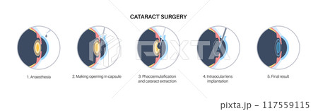 Cataract surgery poster 117559115