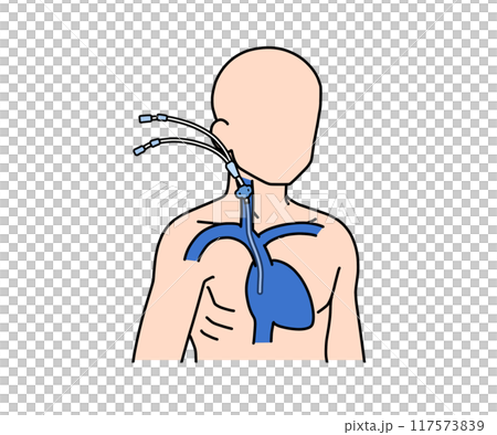 中心静脈カテーテル 117573839