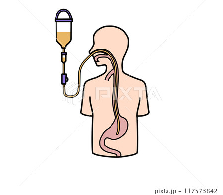 経鼻経管栄養 117573842