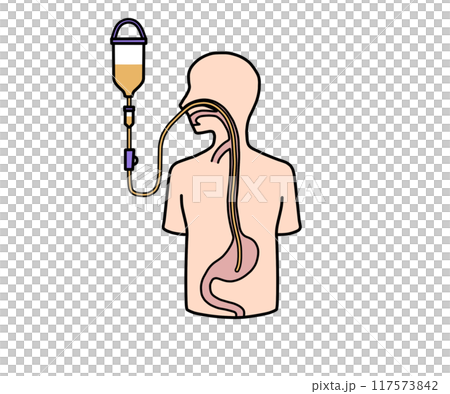 Nasogastric tube feeding 117573842