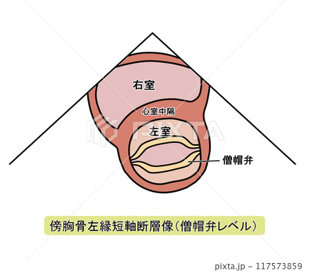傍胸骨左縁短軸断層像僧帽弁レベル(文字あり) 傍胸骨左縁短軸断層像僧帽弁レベル(文字あり) 117573859