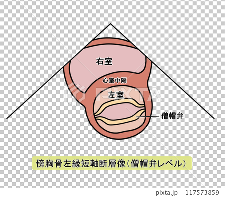 傍胸骨左縁短軸断層像僧帽弁レベル(文字あり) 傍胸骨左縁短軸断層像僧帽弁レベル(文字あり) 117573859