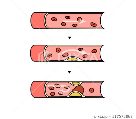 動脈硬化の進行（文字なし） 117573868