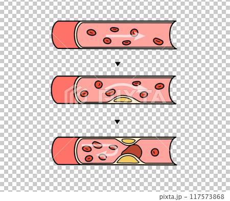 動脈硬化の進行（文字なし） 117573868