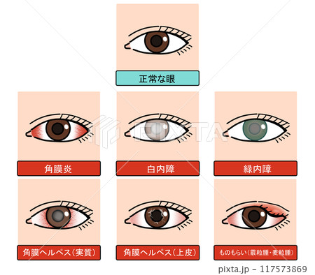 眼の病気（文字あり） 117573869
