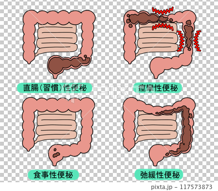 便秘的類型 117573873