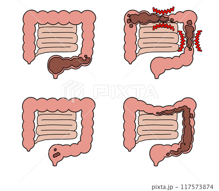 便秘の種類(文字なし) 便秘の種類(文字なし) 117573874