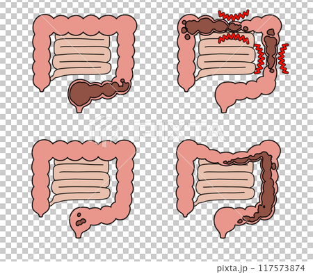 便秘の種類(文字なし) 便秘の種類(文字なし) 117573874