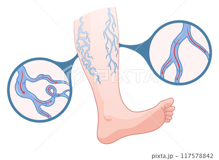 Varicose veins. Blue blood vessel visible through the skin, abnormally swollen leg. Vascular disease diagnostic and treatment. Venous insufficiency medical disease Varicose veins. Blue blood vessel visible through the skin, abnormally swollen leg. Vascular disease diagnostic and treatment. Venous insufficiency medical disease 117578842