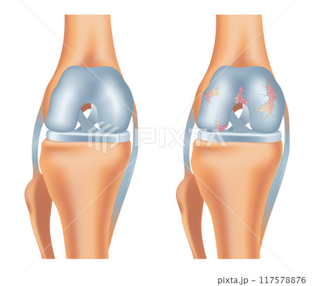 Knee arthrosis. Healthy knee and sore knee with damaged structure. Bone exposure damaged and healthy knee structure comparison. Medical poster with foot bones. Isolated vector illustration 117578876