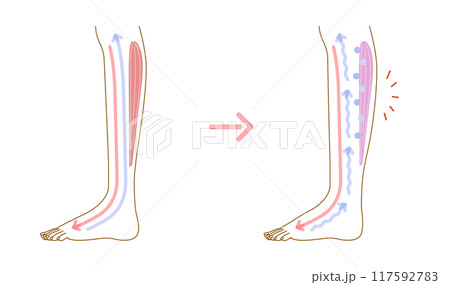 足のむくみ：むくみの発生原因イメージイラスト（断面図） 117592783