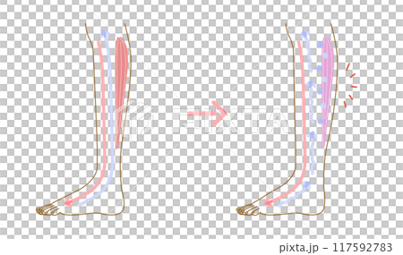 足のむくみ：むくみの発生原因イメージイラスト（断面図） 117592783