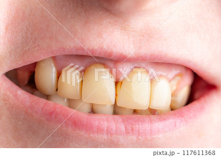 Bad damage tooth, lost teeth Bad damage tooth, lost teeth 117611368