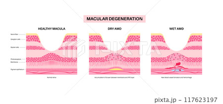 Macular degeneration poster 117623197