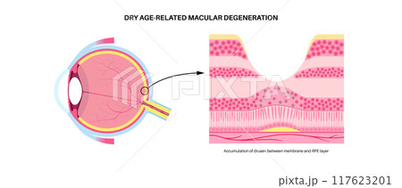 Macular degeneration poster Macular degeneration poster 117623201