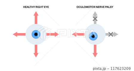 Oculomotor nerve palsy 117623209