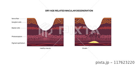 Macular degeneration poster 117623220