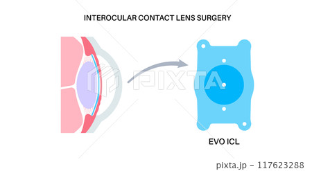EVO ICL poster 117623288