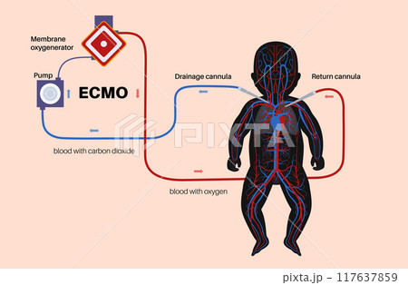 Extracorporeal membrane oxygenation 117637859