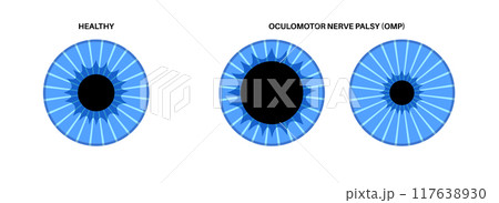 Oculomotor nerve palsy 117638930