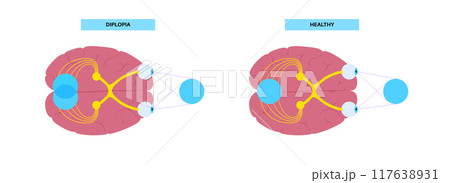 Diplopia medical poster 117638931