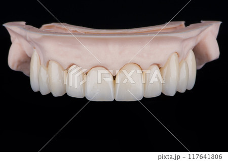 High-quality frontal dental bridge of 10 upper teeth made of zirconium for fixation to upper jaw. High-quality frontal dental bridge of 10 upper teeth made of zirconium for fixation to upper jaw. 117641806