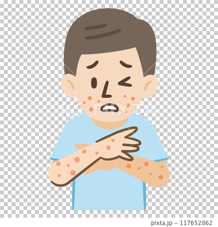 一名感染 Empox 的男子的插圖 117652862