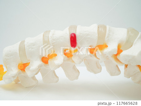 Spinal nerve and bone, Lumbar spine displaced herniated disc fragment, Model for treatment medical in the orthopedic department. Spinal nerve and bone, Lumbar spine displaced herniated disc fragment, Model for treatment medical in the orthopedic department. 117665628