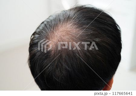Bald head in man, hair loss treatment health problem. Bald head in man, hair loss treatment health problem. 117665641