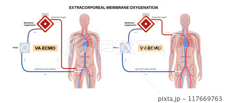 Extracorporeal membrane oxygenation Extracorporeal membrane oxygenation 117669763