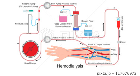 Hemodialysis is a treatment to filter wastes and water. Hemodialysis is a treatment to filter wastes and water. 117676972